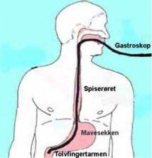 gastroskopi