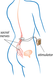 interstim-illust-ext